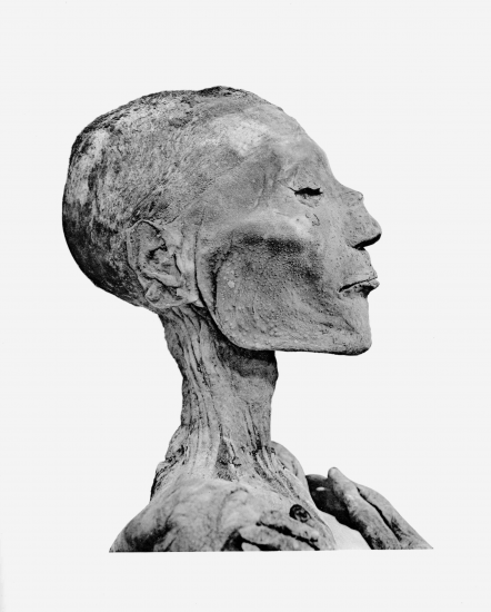 Ramses V Mummy Smallpox